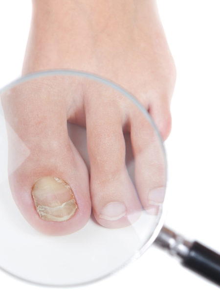 Fungal Nail Treatment